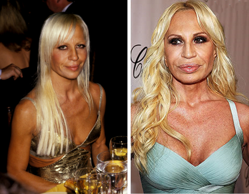 Donatella Versace înainte și după operație: fotografie
