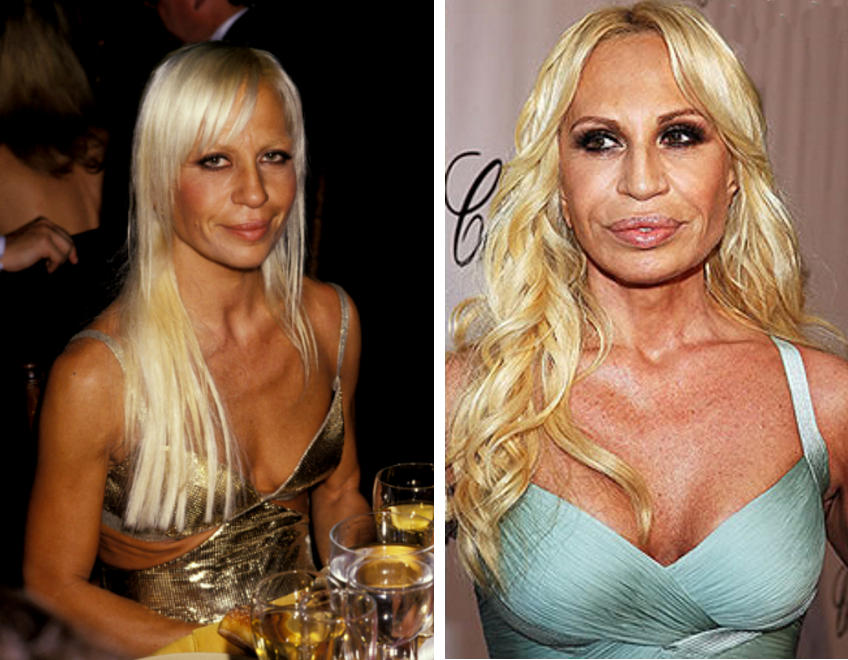 Donatella Versace antes e depois da cirurgia: foto 