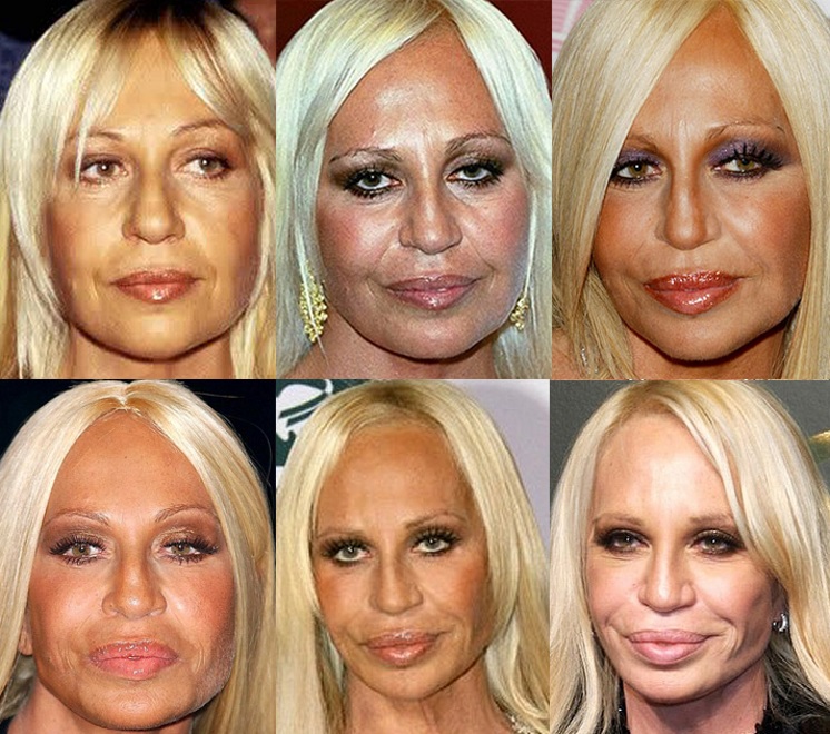 Donatella Versace înainte și după operație: fotografie