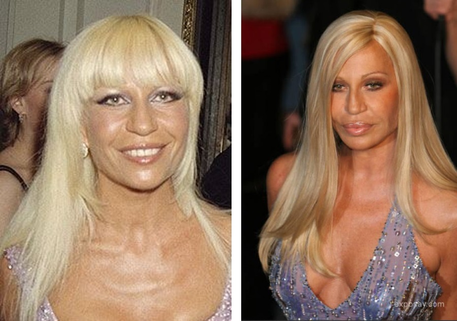 Donatella Versace antes e depois da cirurgia: foto 